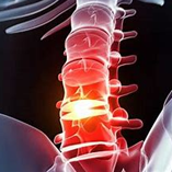 درمان فتق دیسک در کلینیک درد مهر دکتر سیروس علوی