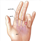 درمان درد انگشت ماشه ای  trigger finger